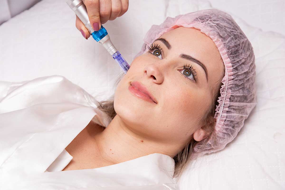 Micro needling Wien, Microneedling wien 1220, Kosmetikstudio Wien 1220